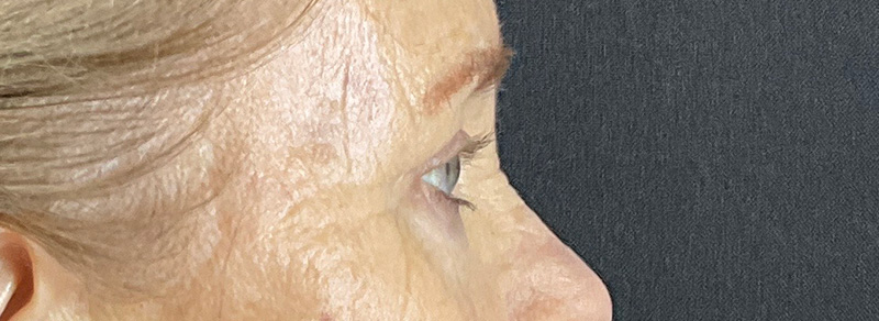 Blepharoplasty Before and After | PERK Plastic Surgery