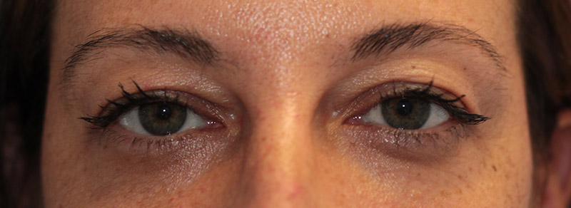Blepharoplasty Before and After | PERK Plastic Surgery