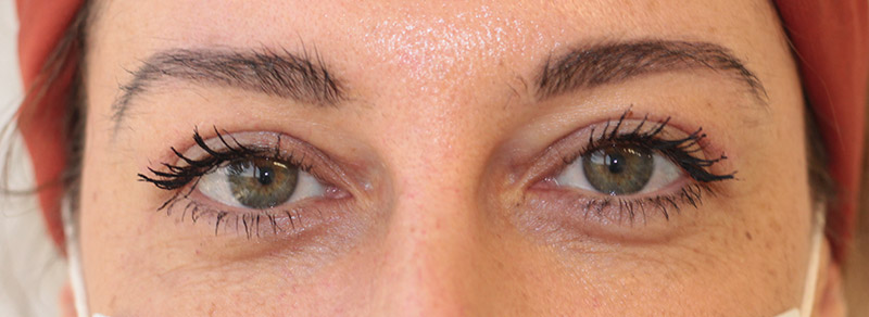 Blepharoplasty Before and After | PERK Plastic Surgery