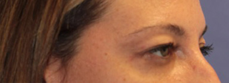 Blepharoplasty Before and After | PERK Plastic Surgery