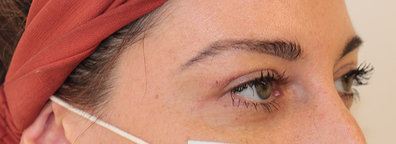 Blepharoplasty Before and After | PERK Plastic Surgery
