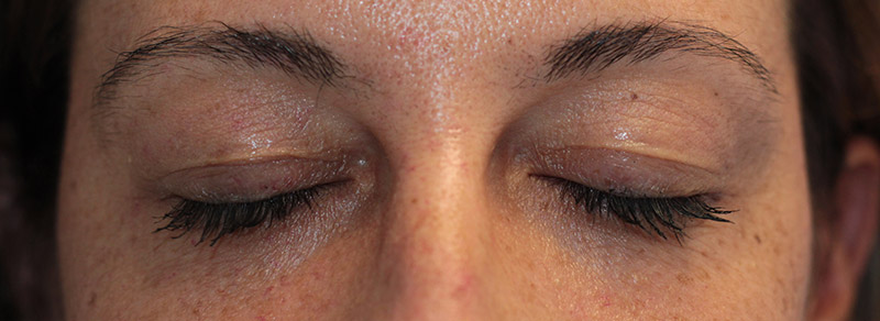 Blepharoplasty Before and After | PERK Plastic Surgery