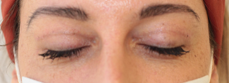 Blepharoplasty Before and After | PERK Plastic Surgery