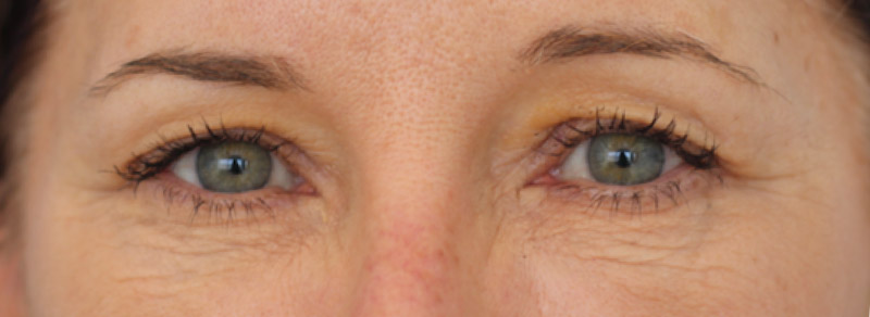 Blepharoplasty Before and After | PERK Plastic Surgery