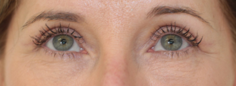 Blepharoplasty Before and After | PERK Plastic Surgery