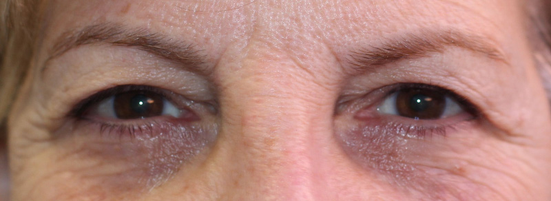 Blepharoplasty Before and After | PERK Plastic Surgery