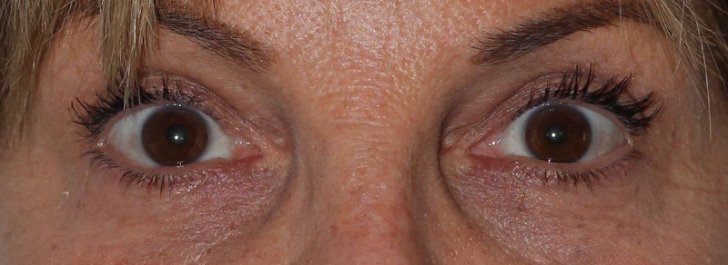 Blepharoplasty Before and After | PERK Plastic Surgery
