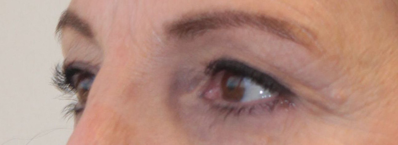 Blepharoplasty Before and After | PERK Plastic Surgery