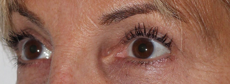 Blepharoplasty Before and After | PERK Plastic Surgery