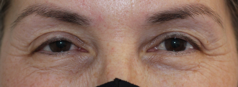 Blepharoplasty Before and After | PERK Plastic Surgery