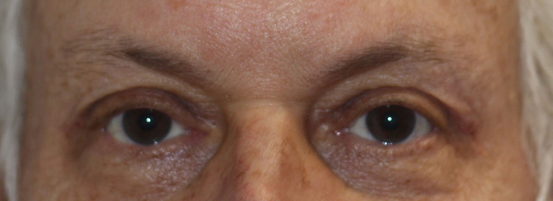 Blepharoplasty Before and After | PERK Plastic Surgery