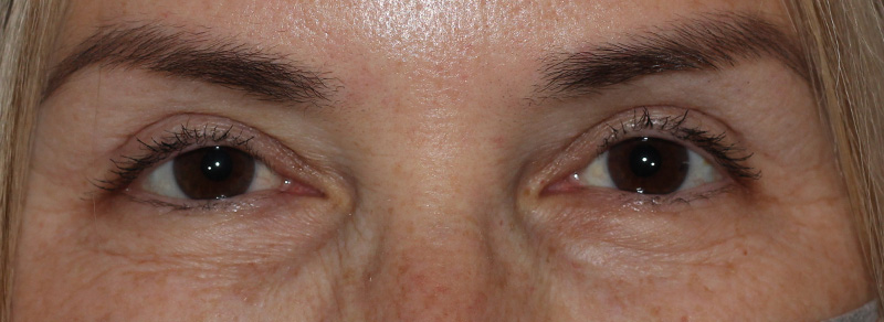 Blepharoplasty Before and After | PERK Plastic Surgery