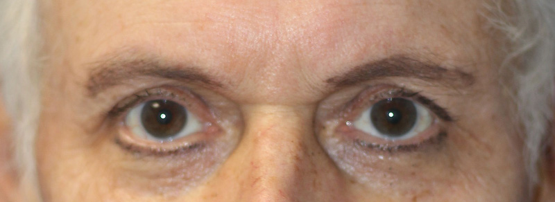 Blepharoplasty Before and After | PERK Plastic Surgery