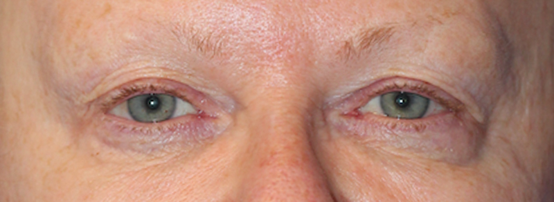 Blepharoplasty Before and After | PERK Plastic Surgery