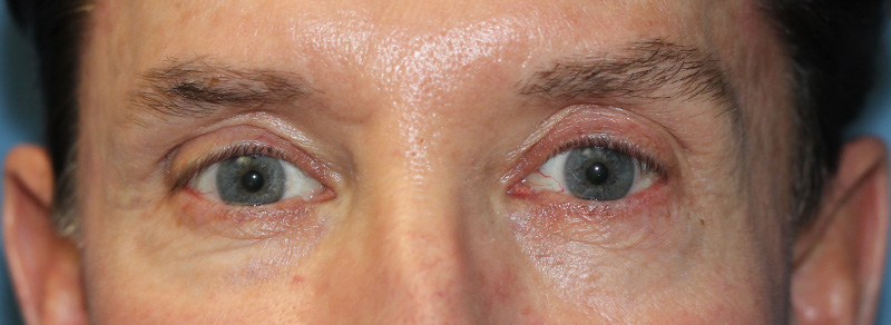 Blepharoplasty Before and After | PERK Plastic Surgery