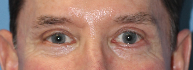 Blepharoplasty Before and After | PERK Plastic Surgery