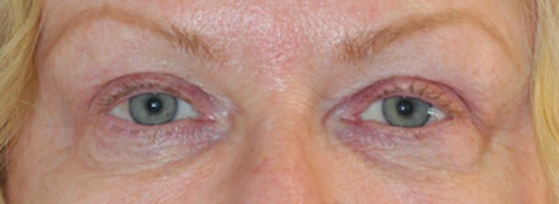 Blepharoplasty Before and After | PERK Plastic Surgery