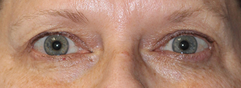 Blepharoplasty Before and After | PERK Plastic Surgery