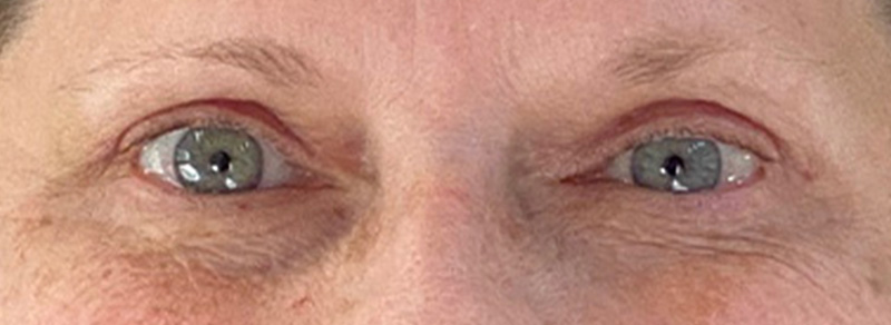 Blepharoplasty Before and After | PERK Plastic Surgery