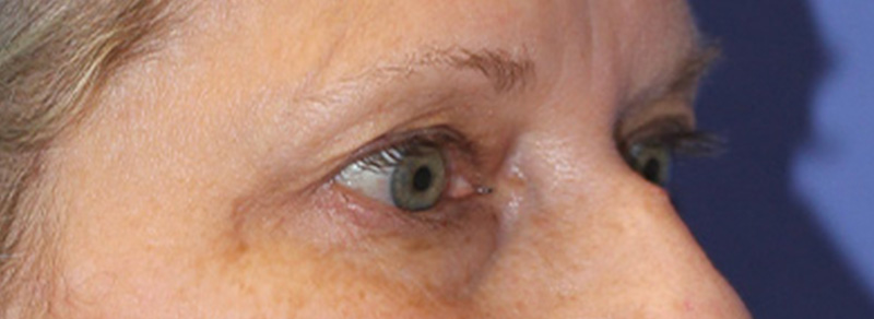 Blepharoplasty Before and After | PERK Plastic Surgery