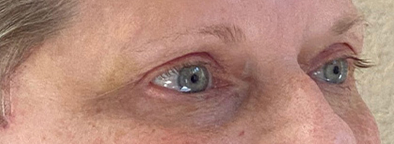 Blepharoplasty Before and After | PERK Plastic Surgery