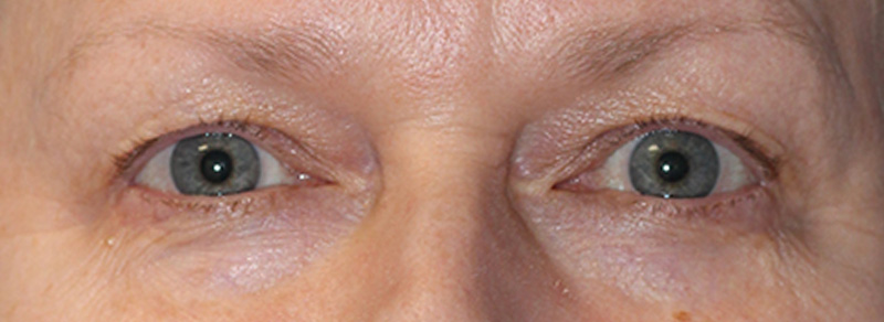 Blepharoplasty Before and After | PERK Plastic Surgery
