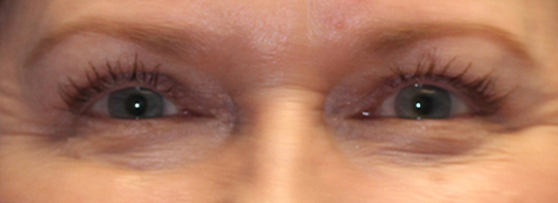 Blepharoplasty Before and After | PERK Plastic Surgery