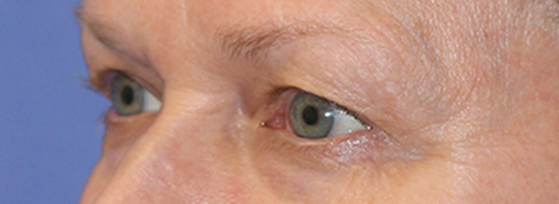 Blepharoplasty Before and After | PERK Plastic Surgery