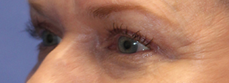 Blepharoplasty Before and After | PERK Plastic Surgery