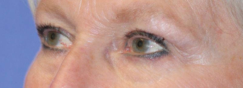 Blepharoplasty Before and After | PERK Plastic Surgery