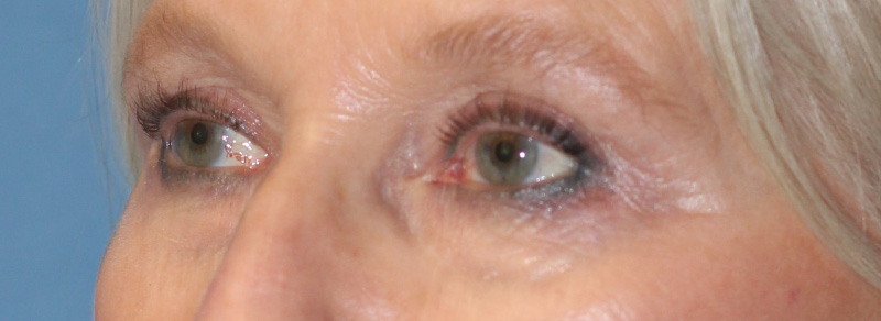 Blepharoplasty Before and After | PERK Plastic Surgery