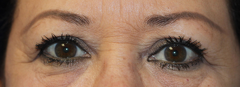 Blepharoplasty Before and After | PERK Plastic Surgery