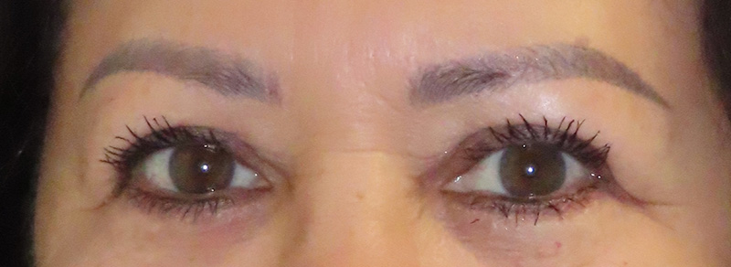 Blepharoplasty Before and After | PERK Plastic Surgery