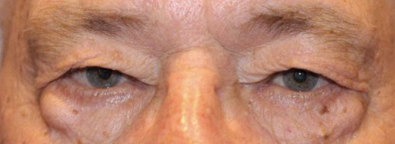 Blepharoplasty Before and After | PERK Plastic Surgery