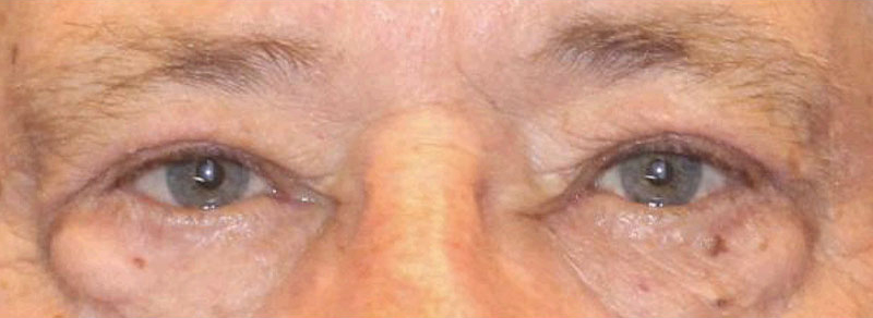 Blepharoplasty Before and After | PERK Plastic Surgery