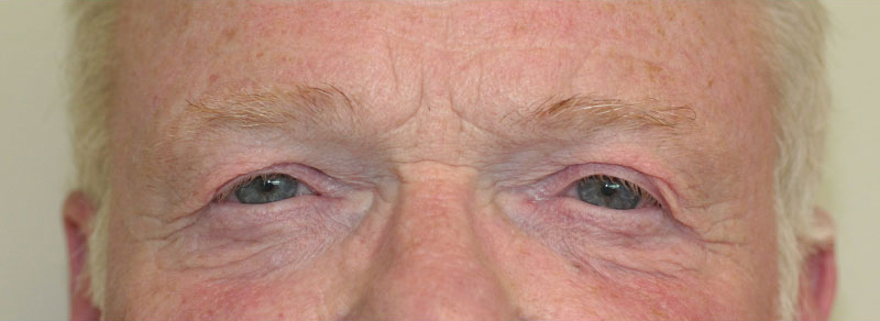 Blepharoplasty Before and After | PERK Plastic Surgery