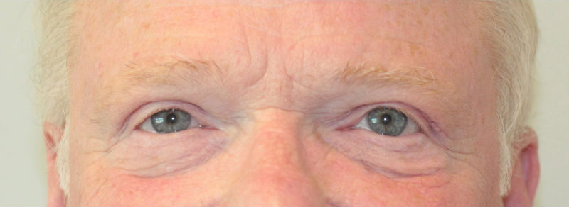 Blepharoplasty Before and After | PERK Plastic Surgery