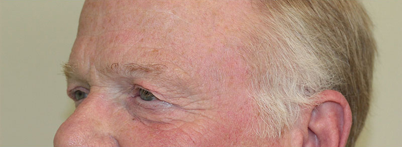 Blepharoplasty Before and After | PERK Plastic Surgery