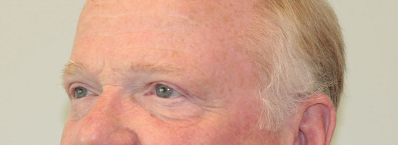 Blepharoplasty Before and After | PERK Plastic Surgery