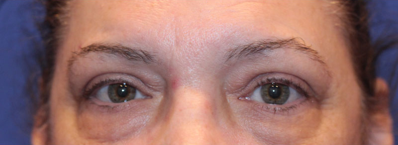 Blepharoplasty Before and After | PERK Plastic Surgery