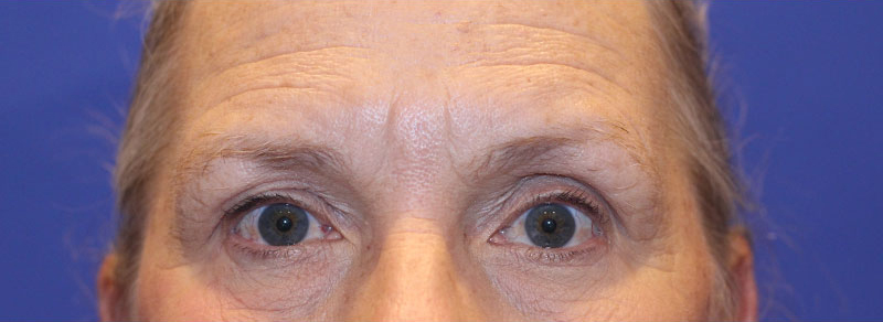Blepharoplasty Before and After | PERK Plastic Surgery