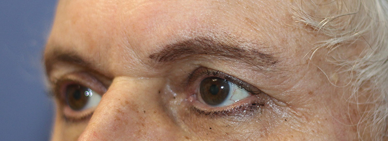 Brow Lift Beverly Hills