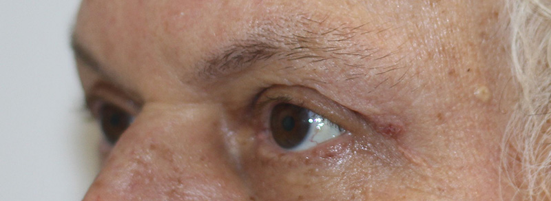 Brow Lift Beverly Hills