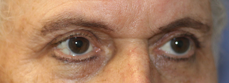 Brow Lift Before and After | PERK Plastic Surgery