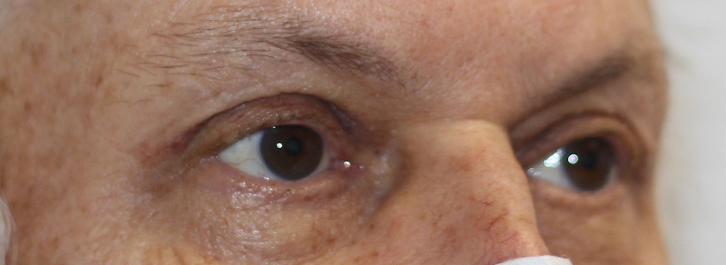 Brow Lift Before and After | PERK Plastic Surgery