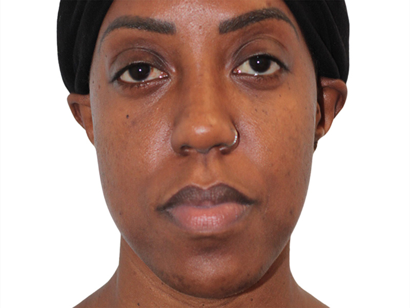 Buccal Fat Removal Before and After | PERK Plastic Surgery