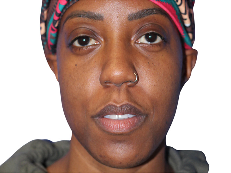 Buccal Fat Removal Before and After | PERK Plastic Surgery