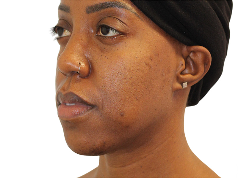 Buccal Fat Removal in Beverly Hills Before and After 1