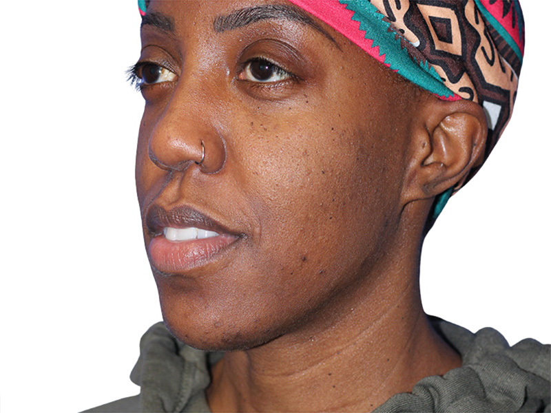 Buccal Fat Removalin Beverly Hills Before and After 2