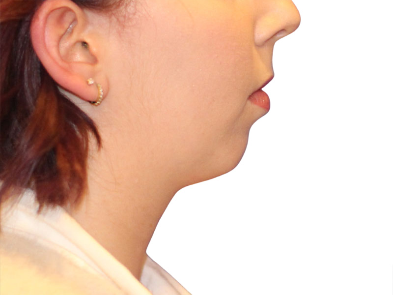 Chin Augmentation Before and After | PERK Plastic Surgery